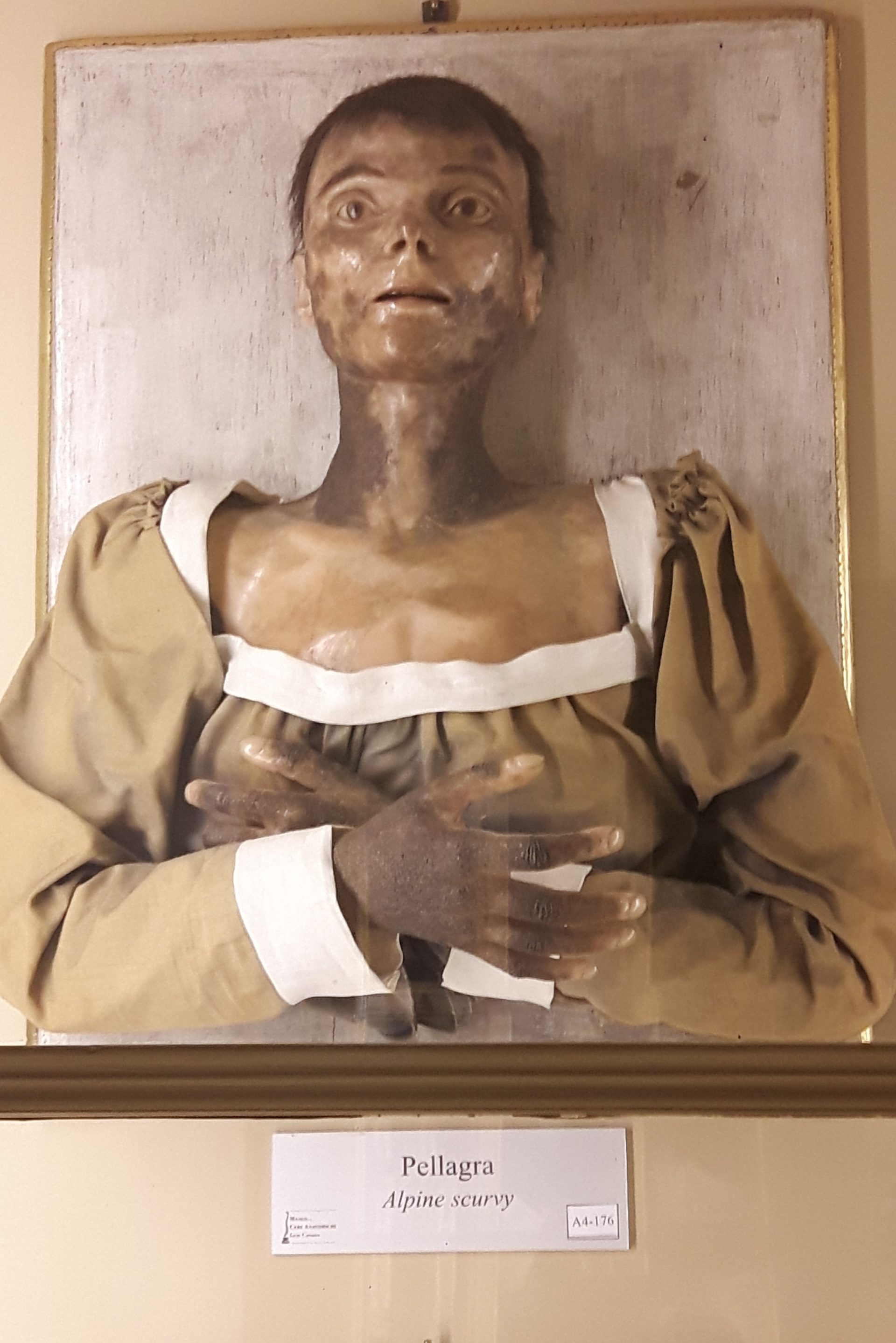 Pellagra wax model, Museo Cattaneo, Bologna (3).jpg